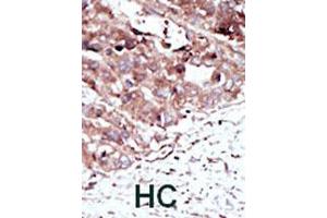 Formalin-fixed and paraffin-embedded human hepatocellular carcinoma tissue reacted with PHKG2 polyclonal antibody  , which was peroxidase-conjugated to the secondary antibody, followed by AEC staining. (PHKG2 antibody  (N-Term))