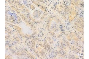 ABIN7096998 and ABIN7101065 at 1/100 staining human lung adenocarcinoma by IHC-P. (ZNF574 antibody)