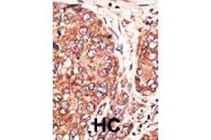 Formalin-fixed and paraffin-embedded human hepatocellular carcinoma tissue reacted with MAFK polyclonal antibody  , which was peroxidase-conjugated to the secondary antibody, followed by AEC staining. (Septin 9 antibody  (C-Term))
