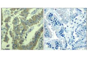 Immunohistochemical analysis of paraffin-embedded human lung carcinoma tissue using MARCKS(Phospho-Ser170) Antibody(left) or the same antibody preincubated with blocking peptide(right). (MARCKS antibody  (pSer170))