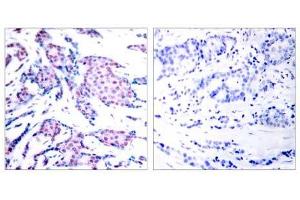 Immunohistochemical analysis of paraffin-embedded human breast carcinoma tissue using c-Jun (phospho-Thr93) antibody (E011022). (C-JUN antibody  (pThr93))