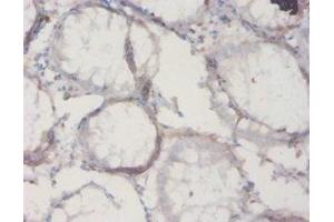 Immunohistochemistry of paraffin-embedded human colon cancer using ABIN7177353 at dilution of 1:20 (IL18BP antibody  (AA 29-193))