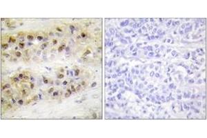 Immunohistochemistry analysis of paraffin-embedded human breast carcinoma tissue, using RORA Antibody. (RORA antibody  (AA 6-55))
