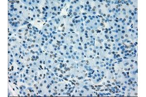 Immunohistochemical staining of paraffin-embedded Adenocarcinoma of colon tissue using anti-NAT8mouse monoclonal antibody. (NAT8 antibody)