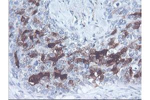 Immunohistochemical staining of paraffin-embedded Adenocarcinoma of Human breast tissue using anti-SERPINB2 mouse monoclonal antibody.