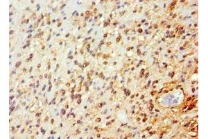 Immunohistochemistry of paraffin-embedded human glioma using ABIN7144651 at dilution of 1:100 (ARNT2 antibody  (AA 440-690))