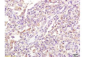 Formalin-fixed and paraffin embedded human pneumonitis tissue labeled with Anti-FPRL1/RFP/Lipoxin A4 receptor Polyclonal Antibody, Unconjugated (ABIN702175) at 1:200 followed by conjugation to the secondary antibody and DAB staining (FPR2 antibody  (AA 51-150))