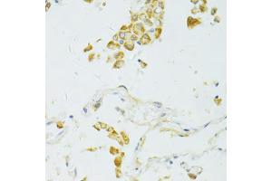 Immunohistochemistry of paraffin-embedded human lung cancer using SIRT2 antibody (ABIN6291363) at dilution of 1:100 (40x lens).