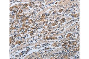 Immunohistochemistry of Human ovarian cancer using SLC34A2 Polyclonal Antibody at dilution of 1:50 (SLC34A2 antibody)