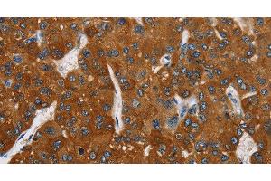 Immunohistochemistry of paraffin-embedded Human liver cancer tissue using CARD9 Polyclonal Antibody at dilution 1:70 (CARD9 antibody)