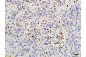 Formalin-fixed and paraffin embedded rat hepatoma labeled with Anti-CXCR2/CD182 Polyclonal Antibody, Unconjugated (ABIN732218) followed by conjugation to the secondary antibody and DAB staining