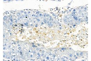 ABIN6258088 and ABIN6273896 at 1/100 staining Human liver cancer by IHC-P. (GPR81 antibody  (C-Term))