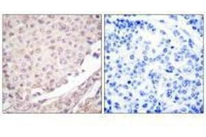 Immunohistochemical analysis of paraffin-embedded human lung carcinoma tissue using Cullin 1 antibody. (Cullin 1 antibody)