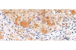 Immunohistochemistry of paraffin-embedded Human liver cancer tissue using ITSN2 Polyclonal Antibody at dilution of 1:40(x200)