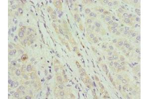Immunohistochemistry of paraffin-embedded human liver cancer using ABIN7144067 at dilution of 1:100 (CIAPIN1 antibody  (AA 1-312))