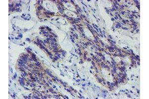 Immunohistochemical staining of paraffin-embedded Carcinoma of Human pancreas tissue using anti-LRRC25 mouse monoclonal antibody. (LRRC25 antibody)