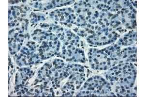 Immunohistochemical staining of paraffin-embedded Adenocarcinoma of breast tissue using anti-CRYAB mouse monoclonal antibody. (CRYAB antibody)