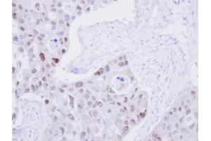 IHC-P Image Immunohistochemical analysis of paraffin-embedded H441 Xenograft, using DNA ligase 3, antibody at 1:100 dilution. (LIG3 antibody  (C-Term))