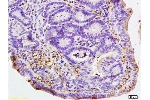 Formalin-fixed and paraffin embedded human colon carcinoma labeled with Rabbit Anti NALP4 Polyclonal Antibody, Unconjugated (ABIN872353) at 1:200 followed by conjugation to the secondary antibody and DAB staining