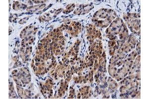 Immunohistochemical staining of paraffin-embedded Carcinoma of Human kidney tissue using anti-CBWD1 mouse monoclonal antibody. (CBWD1 antibody)
