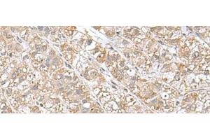 Immunohistochemistry of paraffin-embedded Human liver cancer tissue using EIF1AY Polyclonal Antibody at dilution of 1:55(x200) (EIF1AY antibody)
