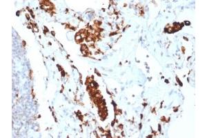 IHC testing of FFPE human lung adenocarcinoma with recombinant Napsin A antibody (clone NAPSA/1865R).