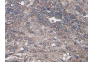 Detection of PTPRF in Human Lung cancer Tissue using Polyclonal Antibody to Protein Tyrosine Phosphatase Receptor Type F (PTPRF) (PTPRF antibody  (AA 30-224))