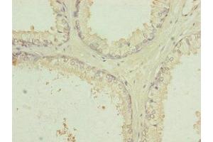 Immunohistochemistry of paraffin-embedded human prostate cancer using ABIN7151092 at dilution of 1:100