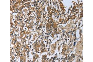 Immunohistochemistry of Human gastic cancer using PRL Polyclonal Antibody at dilution of 1:50