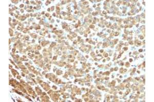 Immunohistochemical staining (Formalin-fixed paraffin-embedded sections) of human melanoma with S100A1 monoclonal antibody, clone S1/61 . (S100A1 antibody)