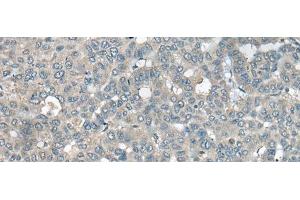 Immunohistochemistry of paraffin-embedded Human liver cancer tissue using UCN3 Polyclonal Antibody at dilution of 1:55(x200) (UCN3 antibody)