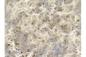 ABIN6260113 and ABIN6272523 at 1/100 staining human melanoma by IHC-P.