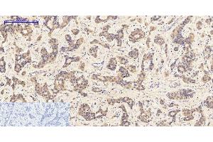 Immunohistochemistry of paraffin-embedded Human liver cancer tissue with Phospho-JAK1 (Tyr1022) Polyclonal Antibody at dilution of 1:200 (JAK1 antibody  (pTyr1022))