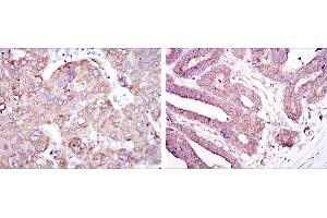 Immunohistochemical analysis of paraffin-embedded liver cancer tissues (left) and stomach cancer tissues (right) using RBP4 mouse mAb with DAB staining. (RBP4 antibody)