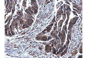 IHC-P Image SDHB antibody [C2C3], C-term detects SDHB protein at mitochindria on human colon carcinoma by immunohistochemical analysis. (SDHB antibody  (C-Term))