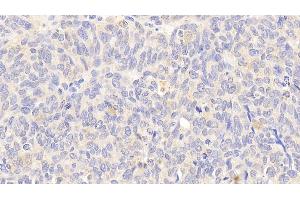 Detection of HSPA8 in Human Ovarian cancer Tissue using Polyclonal Antibody to Heat Shock 70 kDa Protein 8 (HSPA8) (Hsc70 antibody  (AA 534-615))