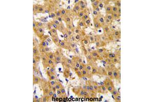 Formalin-fixed and paraffin-embedded human hepatocarcinomareacted with PDHX polyclonal antibody , which was peroxidase-conjugated to the secondary antibody, followed by AEC staining.