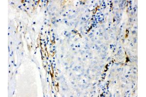 Anti- CYP1B1 Picoband antibody,IHC(P) IHC(P): Human Liver Cancer Tissue (CYP1B1 antibody  (AA 255-480))