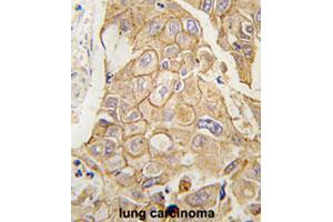 Formalin-fixed and paraffin-embedded human lung carcinomareacted with ADCY2 polyclonal antibody , which was peroxidase-conjugated to the secondary antibody, followed by AEC staining. (ADCY2 antibody  (C-Term))