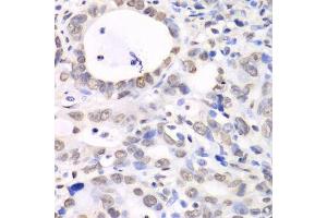 Immunohistochemistry of paraffin-embedded human gastric cancer using Nono Antibody. (NONO antibody  (AA 1-300))