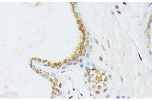 Immunohistochemistry of paraffin-embedded Human breast cancer using ANKRD52 Polyclonal Antibody at dilution of 1:100 (40x lens).