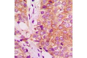 Immunohistochemical analysis of Filamin A staining in human breast cancer formalin fixed paraffin embedded tissue section. (Filamin A antibody  (C-Term))