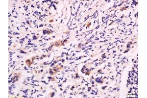 Formalin-fixed and paraffin embedded human colon cancer labeled with Anti-CD53 Polyclonal Antibody, Unconjugated  at 1:200 followed by conjugation to the secondary antibody and DAB staining.
