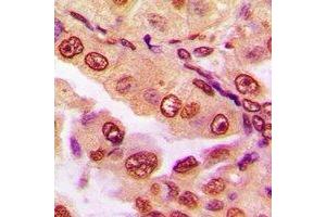 Immunohistochemical analysis of DPF2 staining in human lung cancer formalin fixed paraffin embedded tissue section.