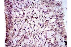 Immunohistochemical analysis of paraffin-embedded rectum cancer tissues using PIWIL4 mouse mAb with DAB staining. (PIWIL4 antibody  (AA 304-434))