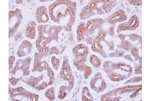 IHC-P Image Immunohistochemical analysis of paraffin-embedded human breast cancer, using DDR2, antibody at 1:250 dilution. (DDR2 antibody  (C-Term))