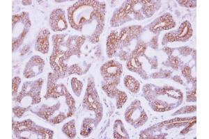 IHC-P Image Immunohistochemical analysis of paraffin-embedded human breast cancer, using DDR2, antibody at 1:250 dilution.