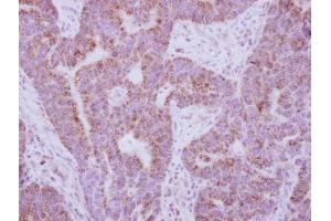 IHC-P Image Immunohistochemical analysis of paraffin-embedded human colon carcinoma, using IL10 Receptor alpha, antibody at 1:250 dilution. (IL-10RA antibody)
