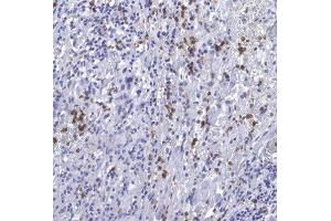 Calprotectin positive cells in tumor stroma. (Calprotectin antibody)