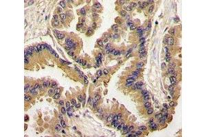 IHC analysis of FFPE human lung carcinoma tissue stained with BMP6 antibody (BMP6 antibody  (AA 25-55))